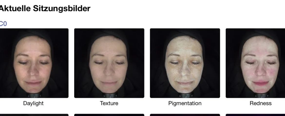 OBSERV 320x Sitzungsbilder: Daylight, Texture, Pigmentation und Redness